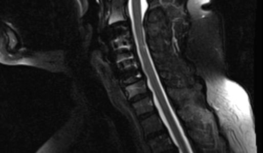 Anterior Cervical Discectomy & Fusion