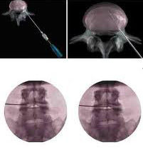 Disc Nucleoplasty