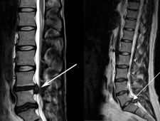 Lumbar Discectomy