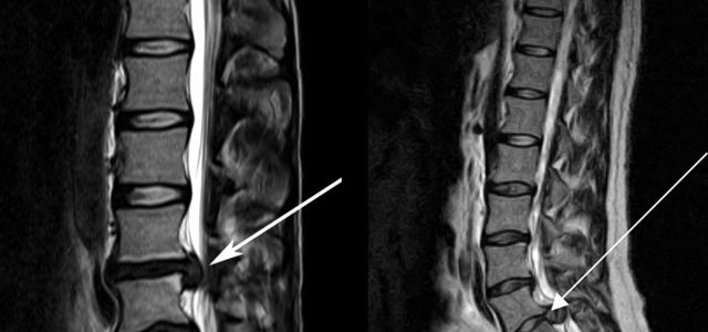 Lumbar Discectomy