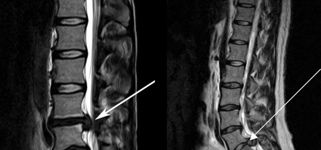 Lumbar Discectomy