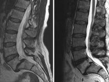 Lumbosacral Spondylolisthesis