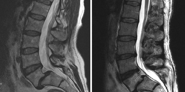 Lumbosacral Spondylolisthesis